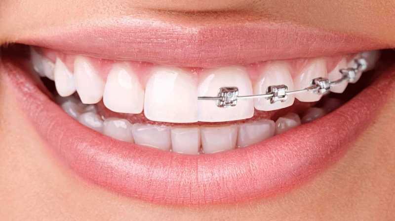 Is Invisalign Better Than Braces?